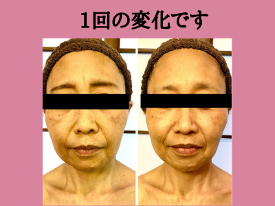 ５０代主婦、キュッとリフト、１度の施術のbefore＆after