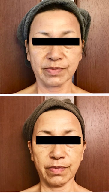 ６０代　美肌再生ピーリング　１回のbefore&after