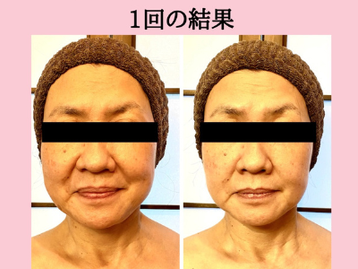 ５０代主婦　美肌再生ピーリング　１回施術のbefore＆after